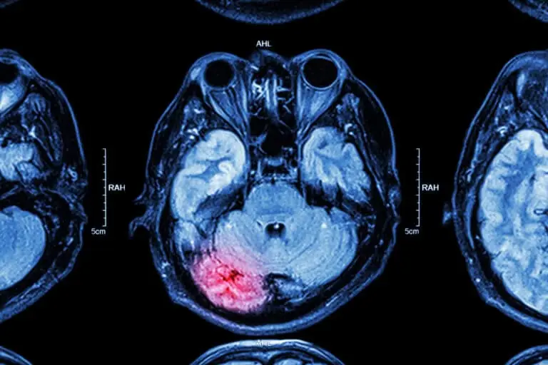 impairment rating for a traumatic brain injury