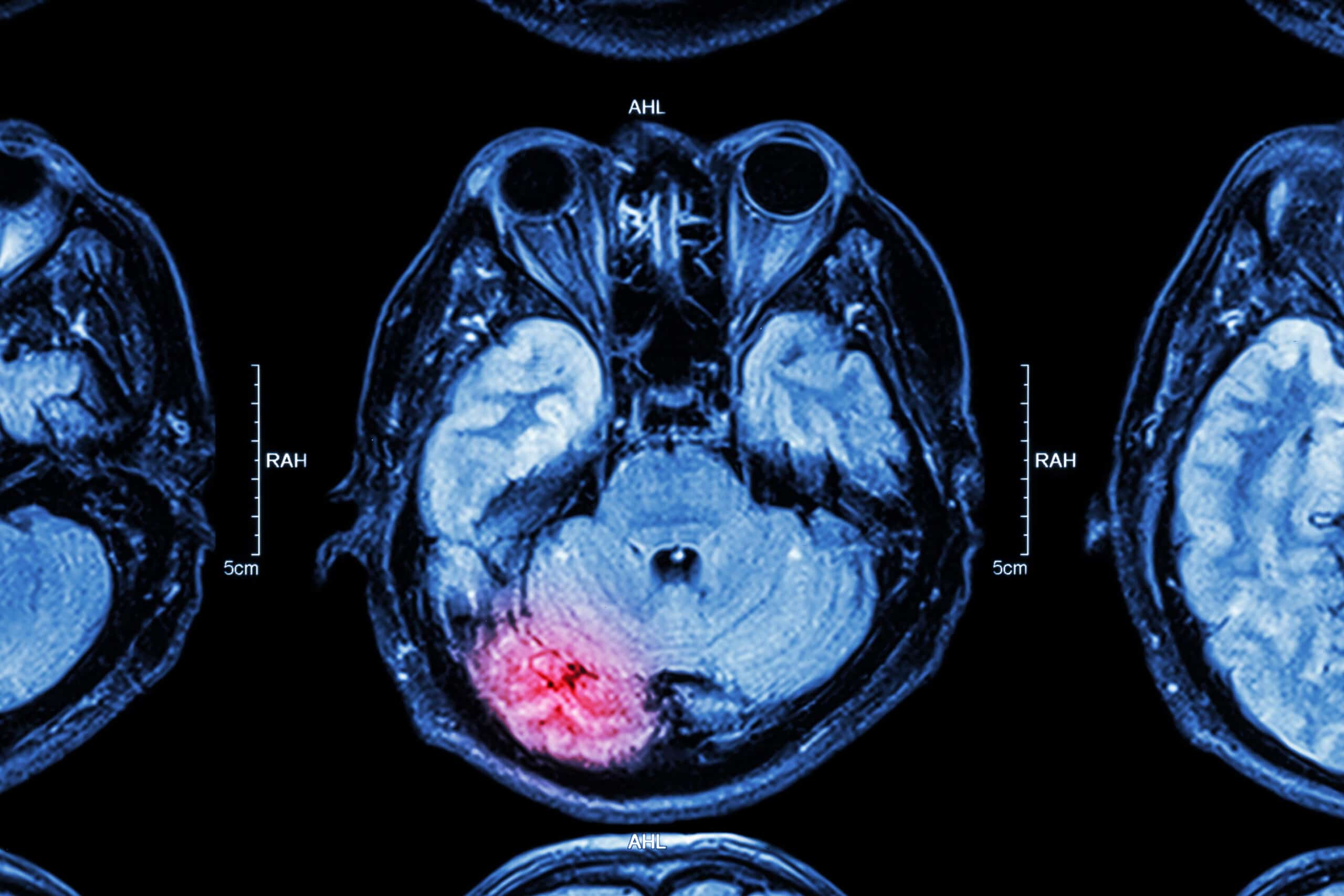 impairment rating for a traumatic brain injury