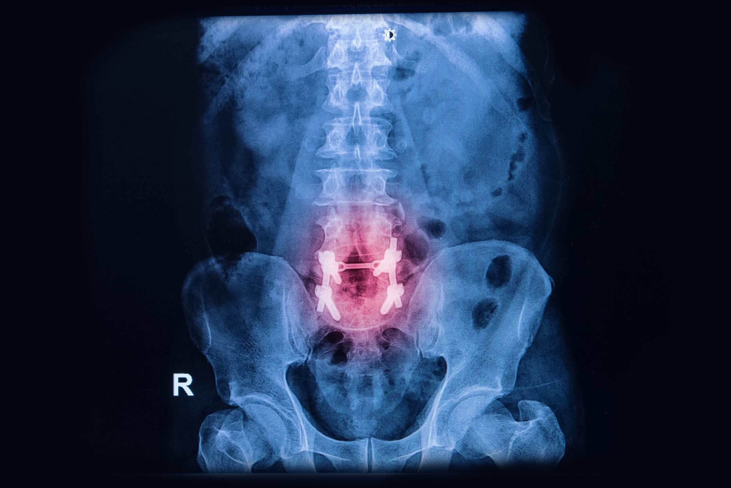 cauda equina syndrome