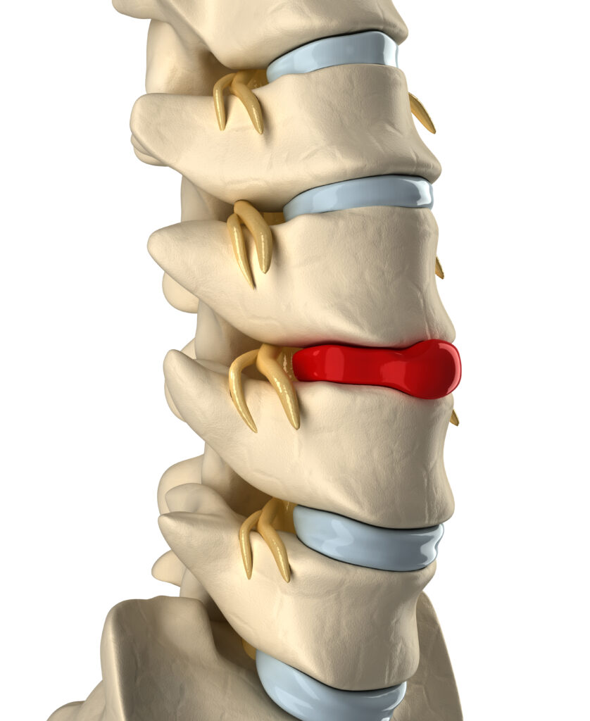 herniated disc and social security disability