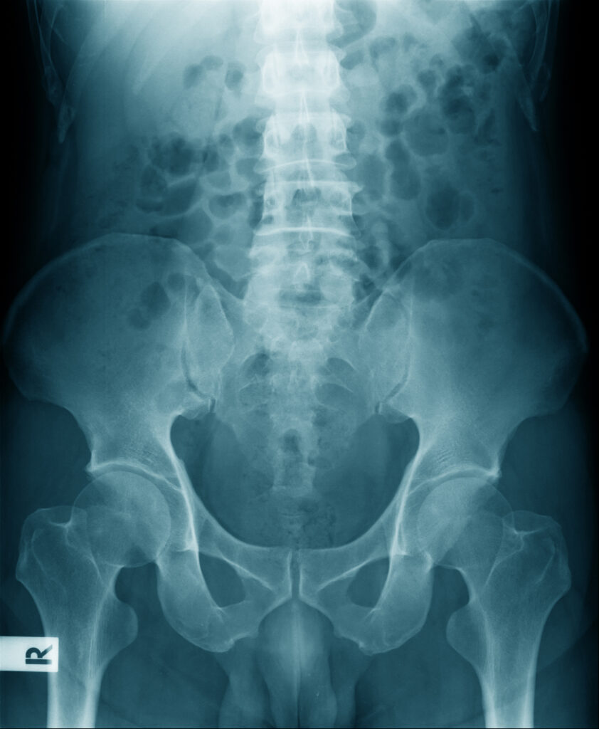 hip dysfunction and social security disability benefits