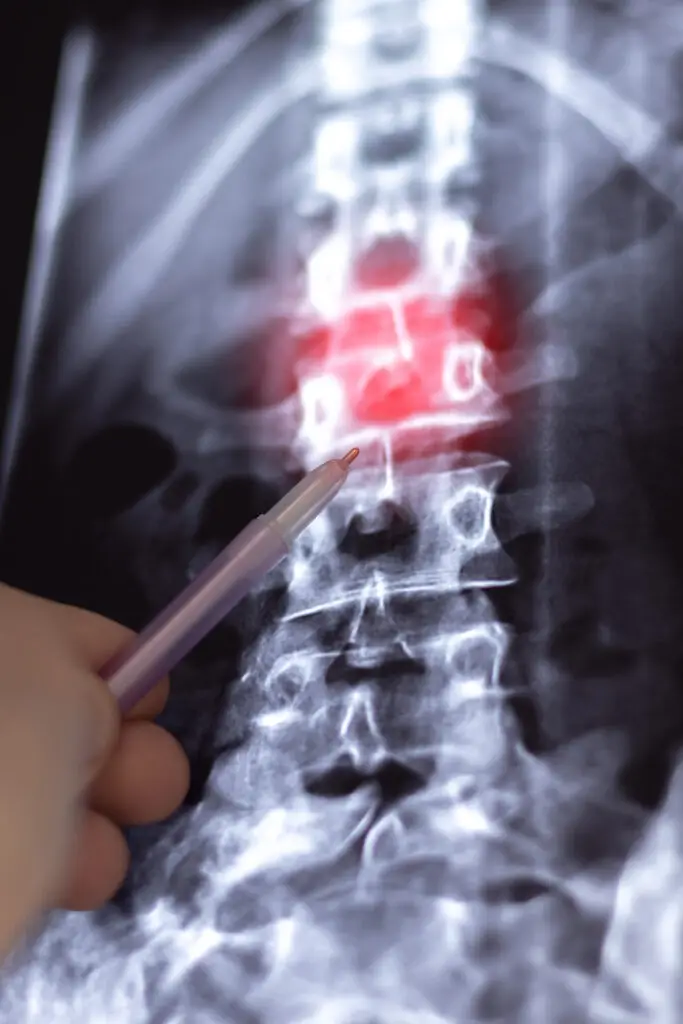 herniated disc and social security disability