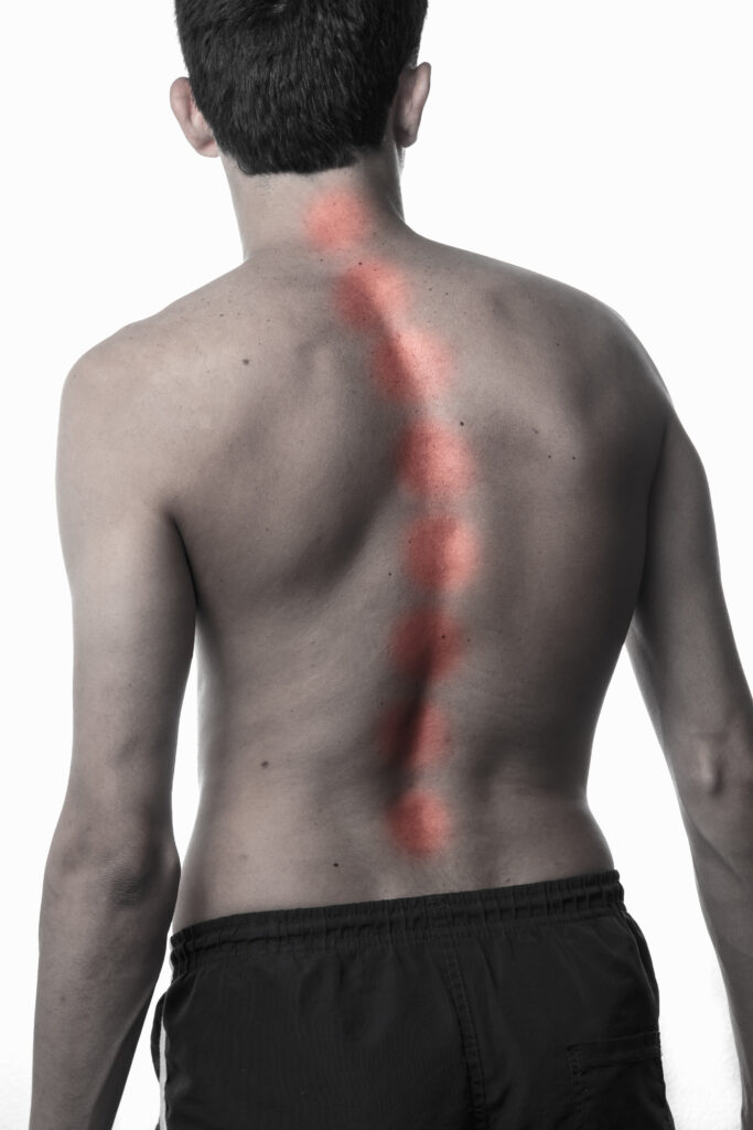 scoliosis and social security disability
