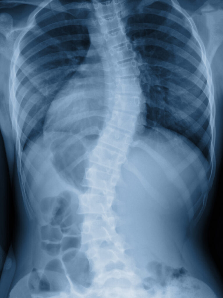 scoliosis and social security disability