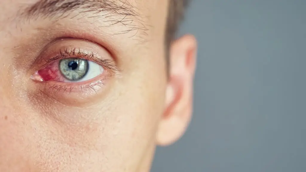 Sjogren's Syndrome and Social Security Disability