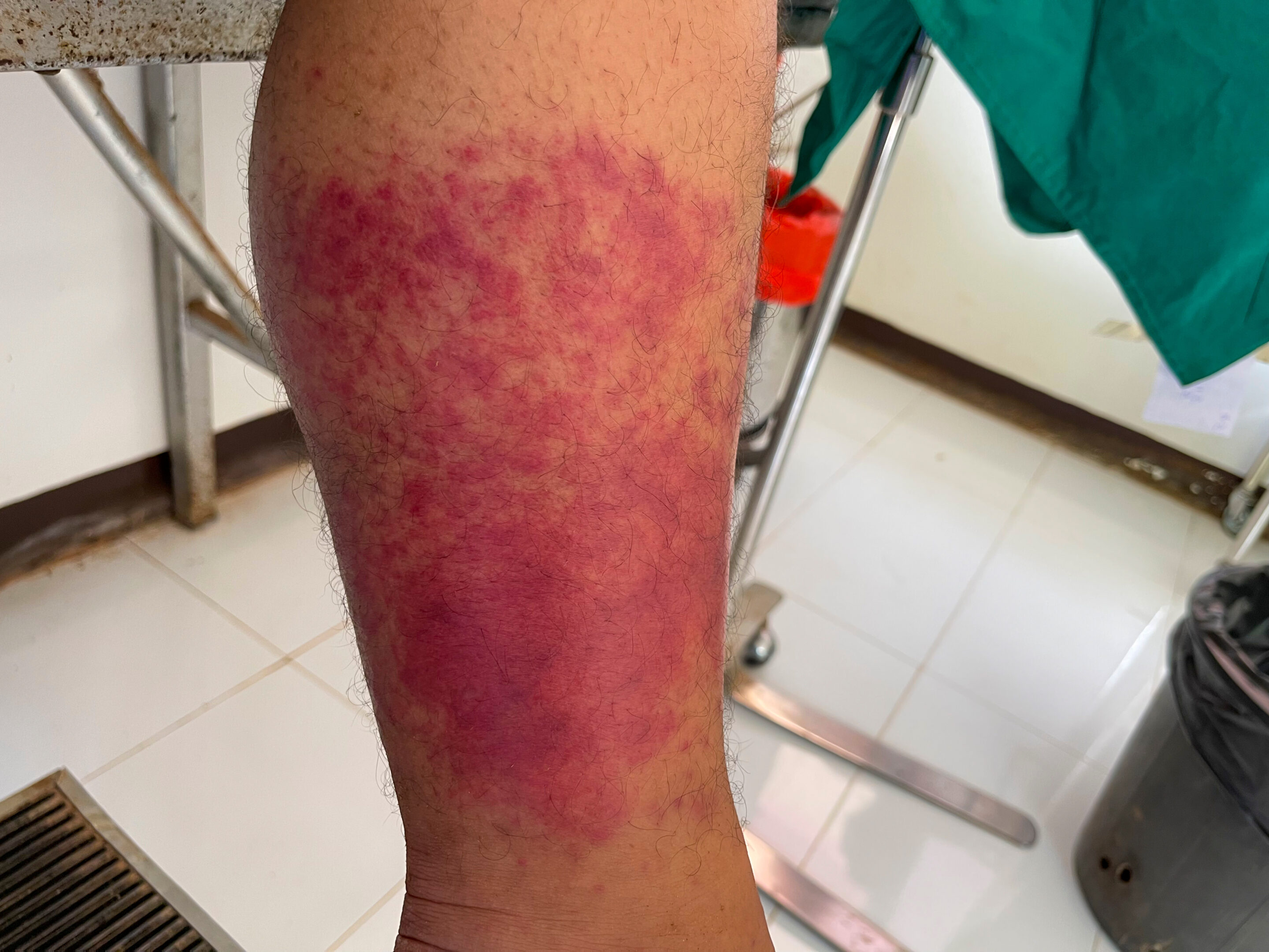 Scleroderma Legs Rash Scleroderma and Social Security Disability Benefits Guide