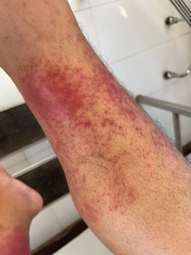 Scleroderma and Social Security Disability