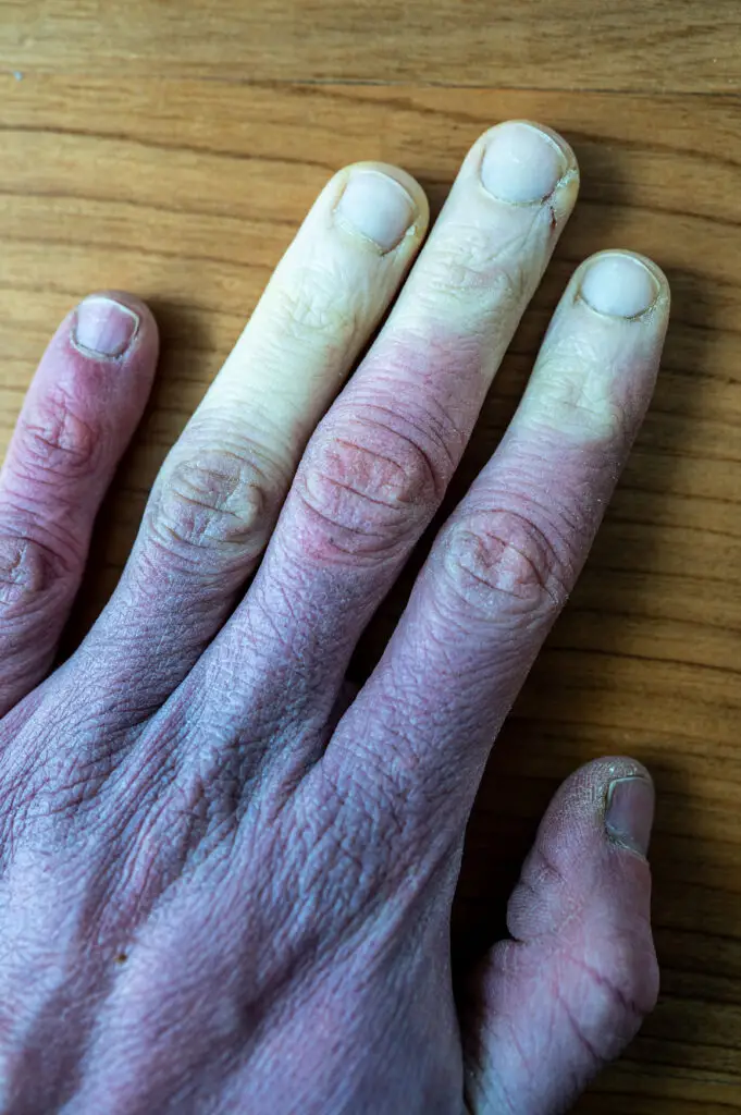 Autoimmune Order and Social Security Disability