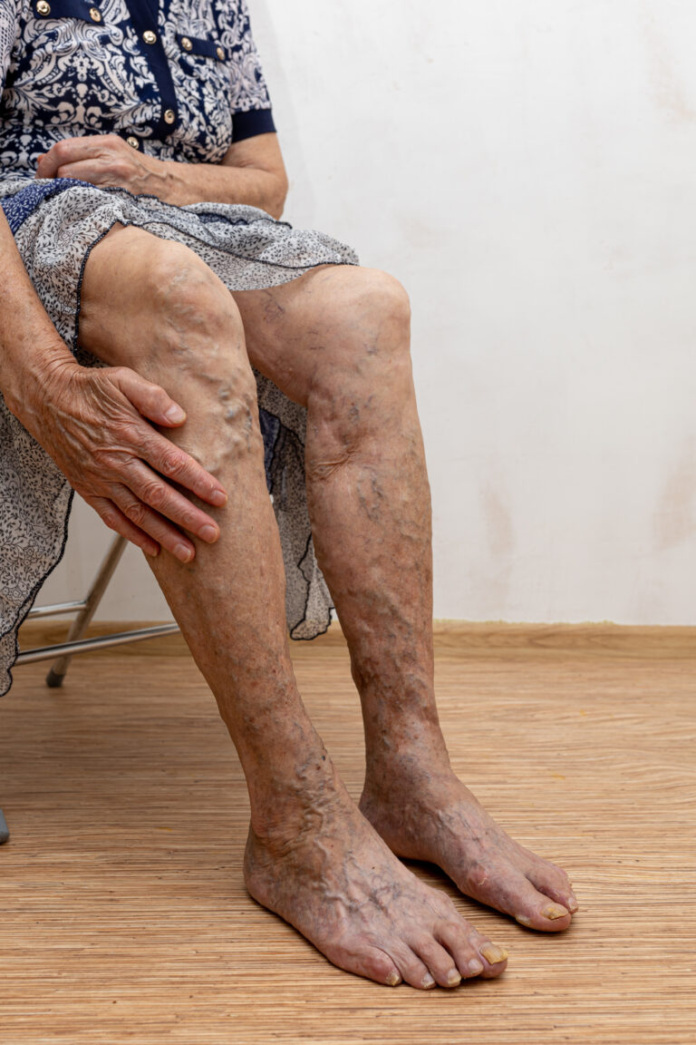 Peripheral Artery Disease and Social Security Disability