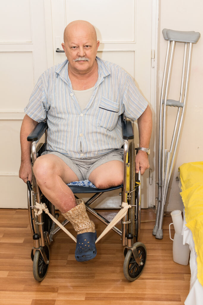 amputations and social security disability