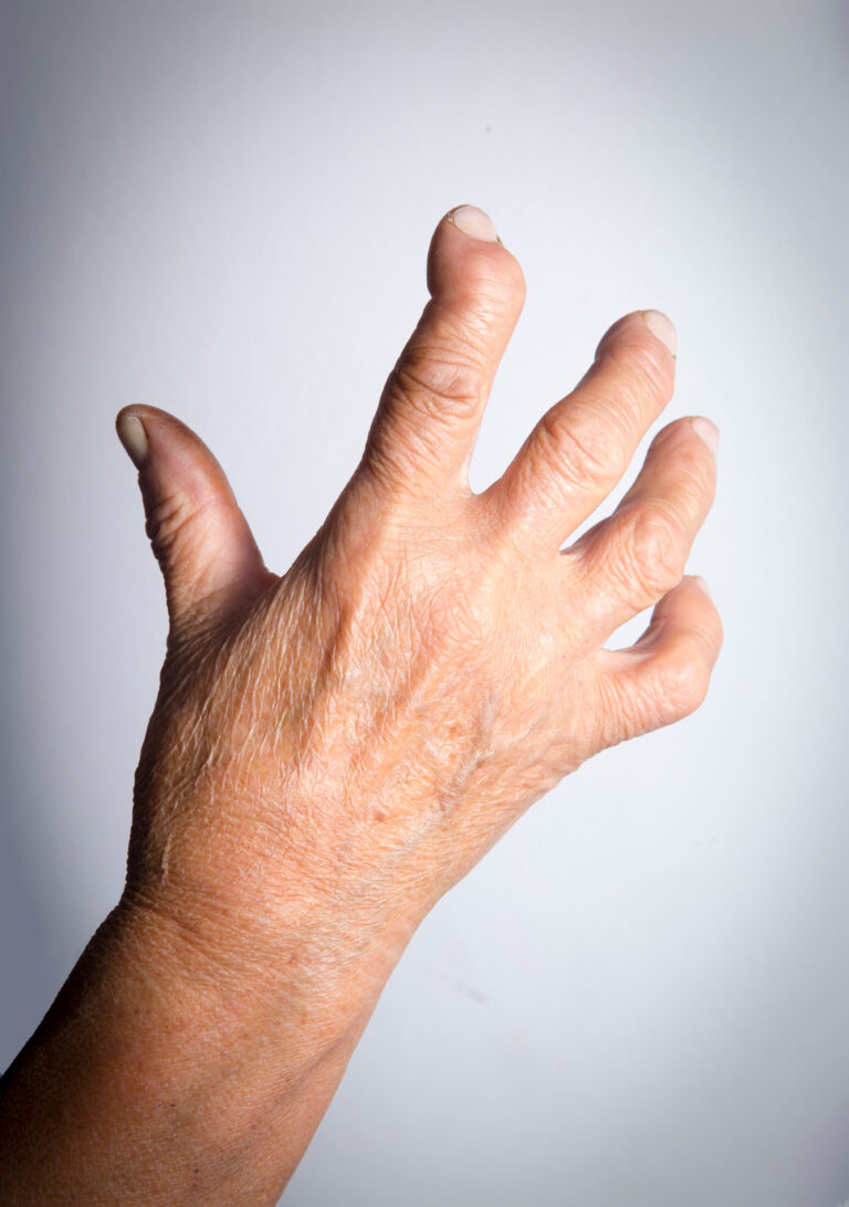 rheumatoid arthritis and social security disability