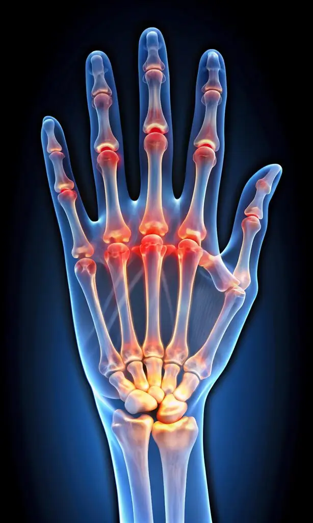 osteoarthritis and social security disability