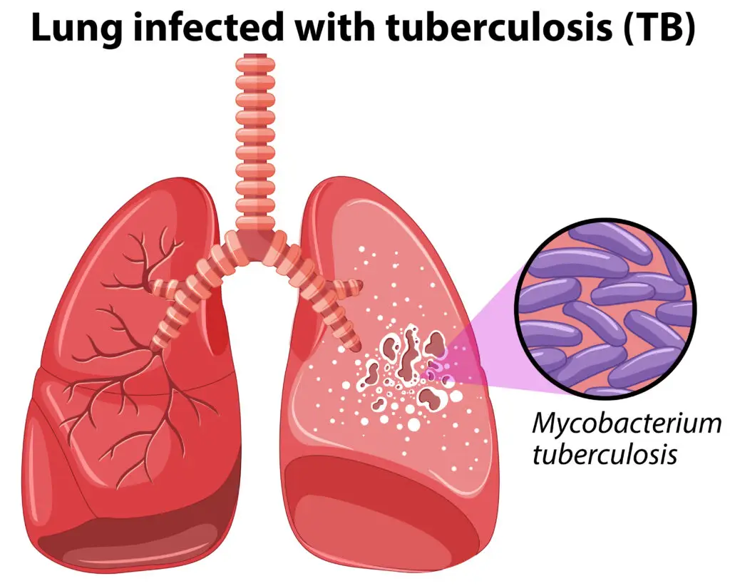 Chronic Lung Infections and Social Security Disability