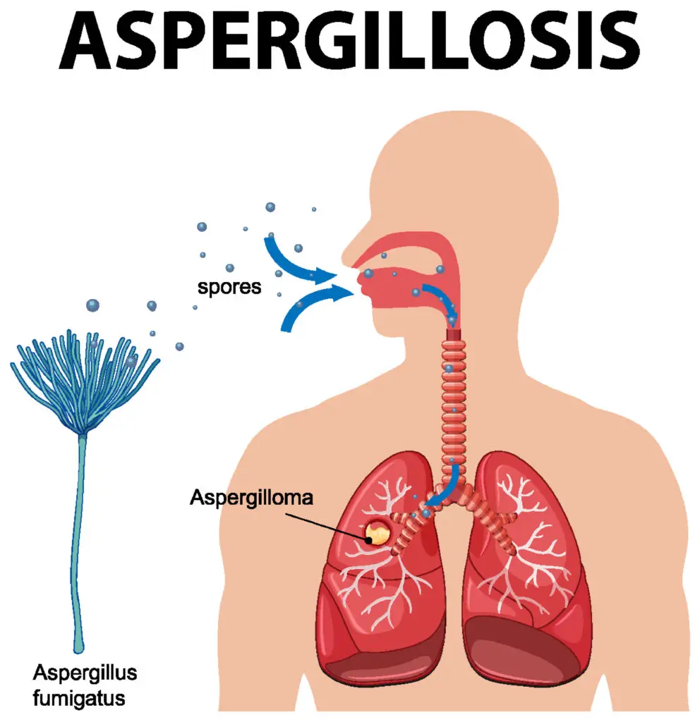 Chronic Lung Infections and Social Security Disability