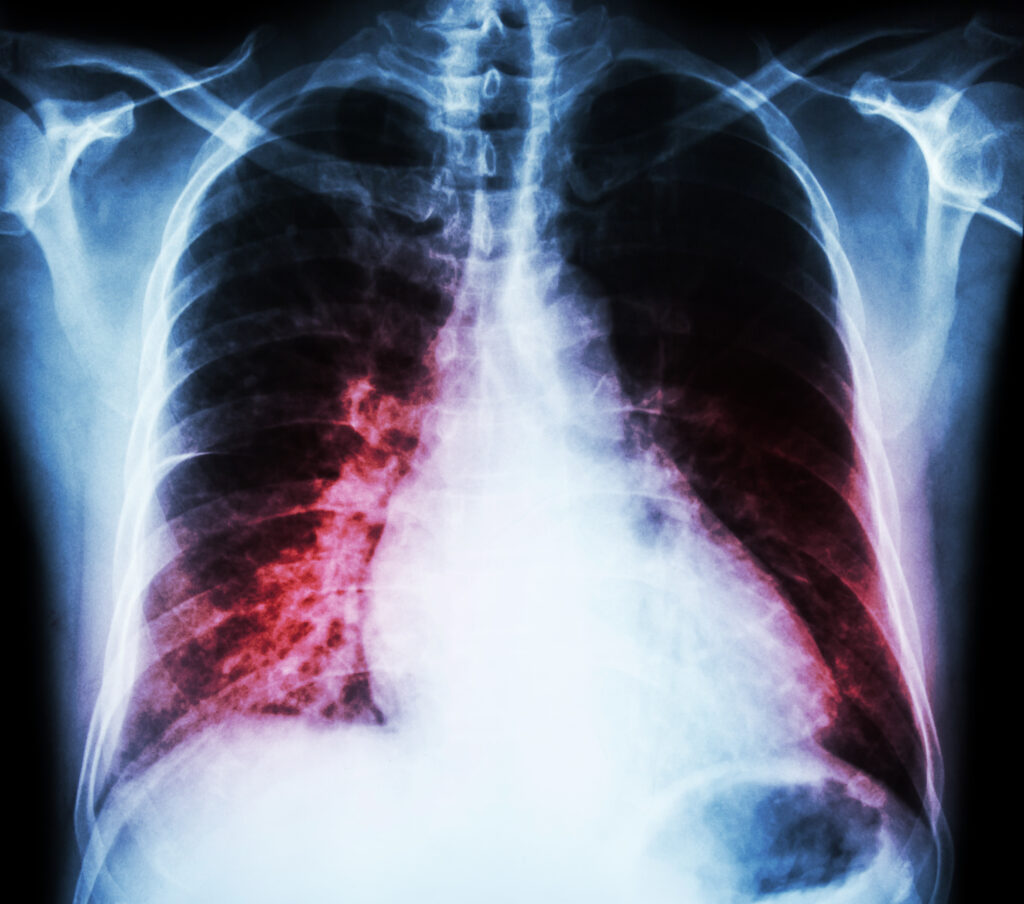 respiratory failure and social security disability