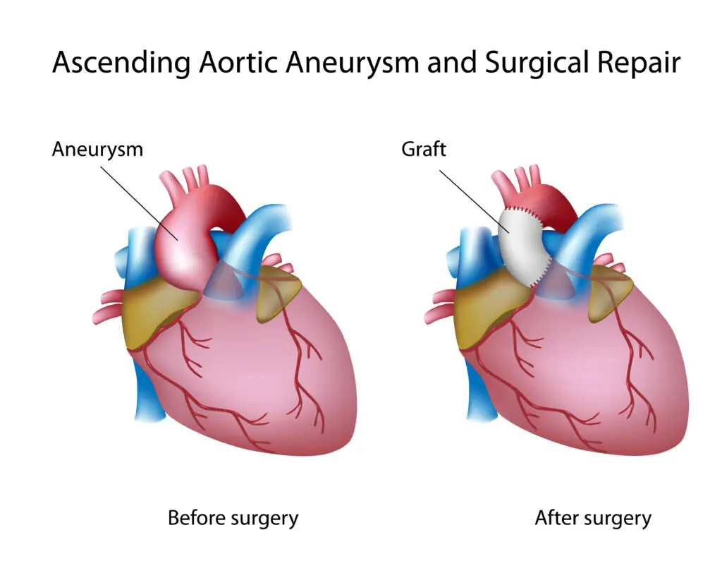 Aneurysms and Social Security Disability