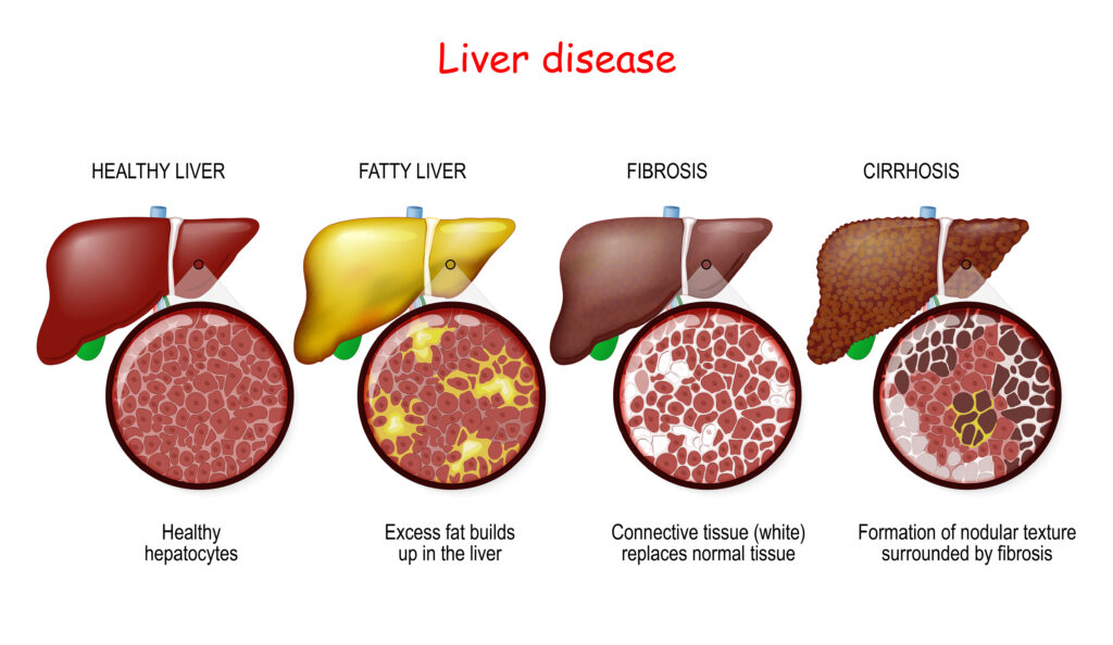 Chronic Liver Disease and Social Security Disability
