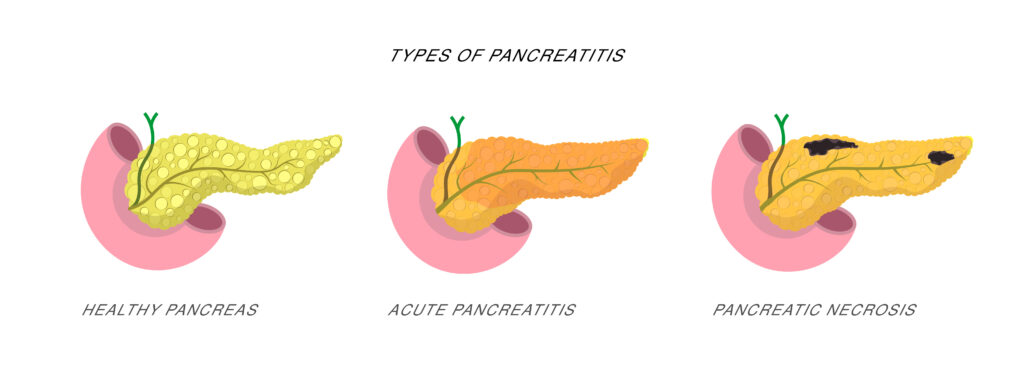 Pancreatitis and Social Security Disability
