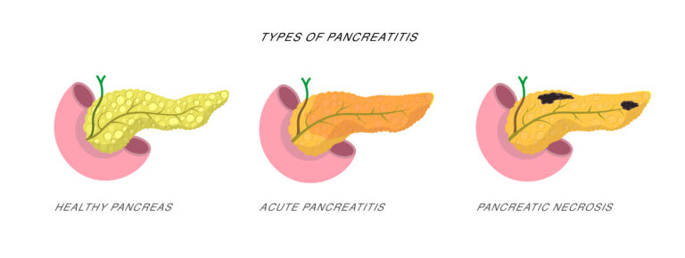 Pancreatitis and Social Security Disability
