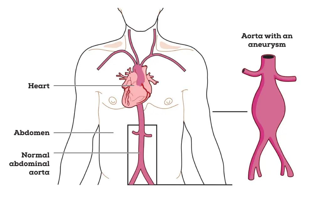 Aneurysms and Social Security Disability