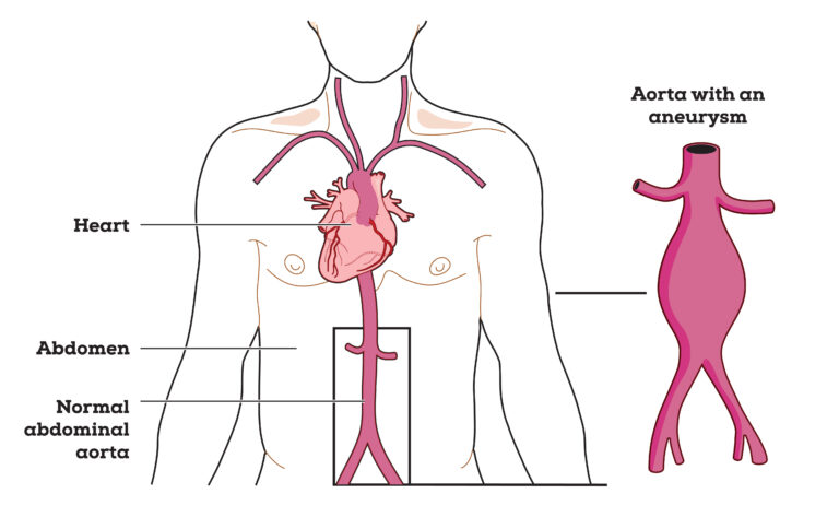 Aneurysms and Social Security Disability