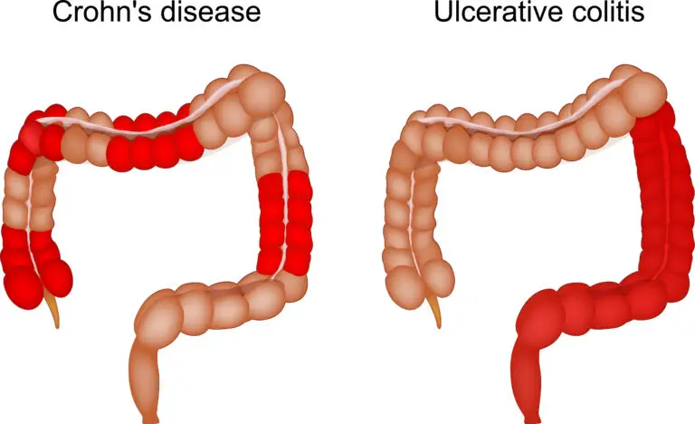 Inflammatory Bowel Disease and Social Security Disability