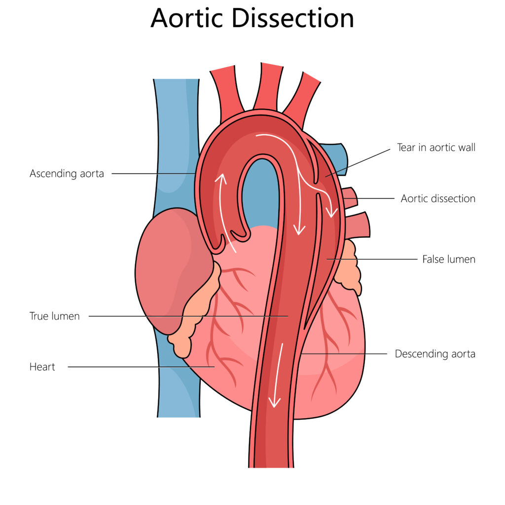 Aortic Dissection and Social Security Disability