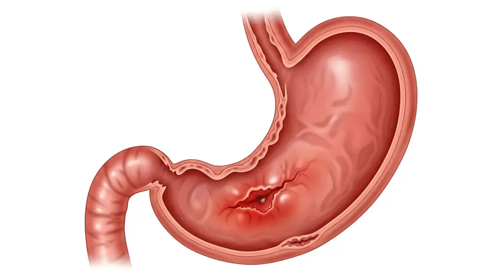 gastrointestinal hemorrhaging and social security disability