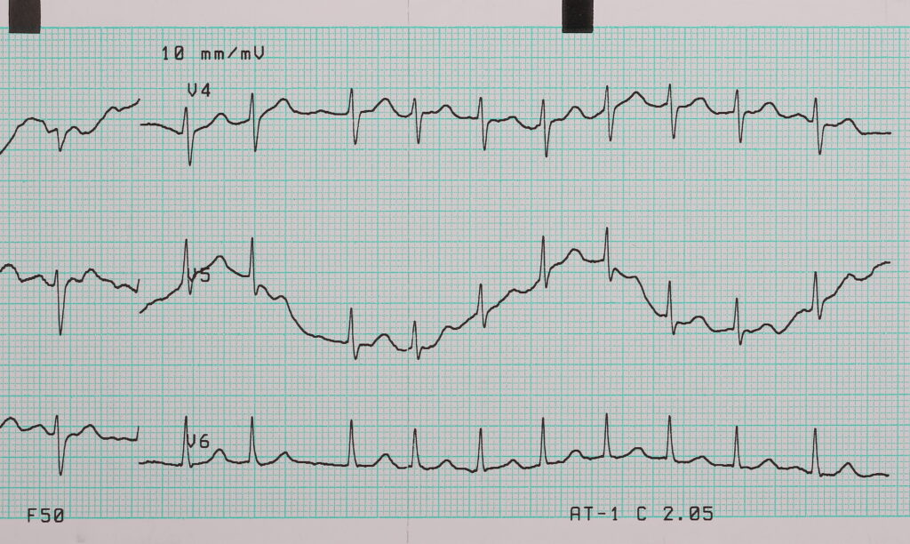 Chronic Heart Failure and Social Security Disability