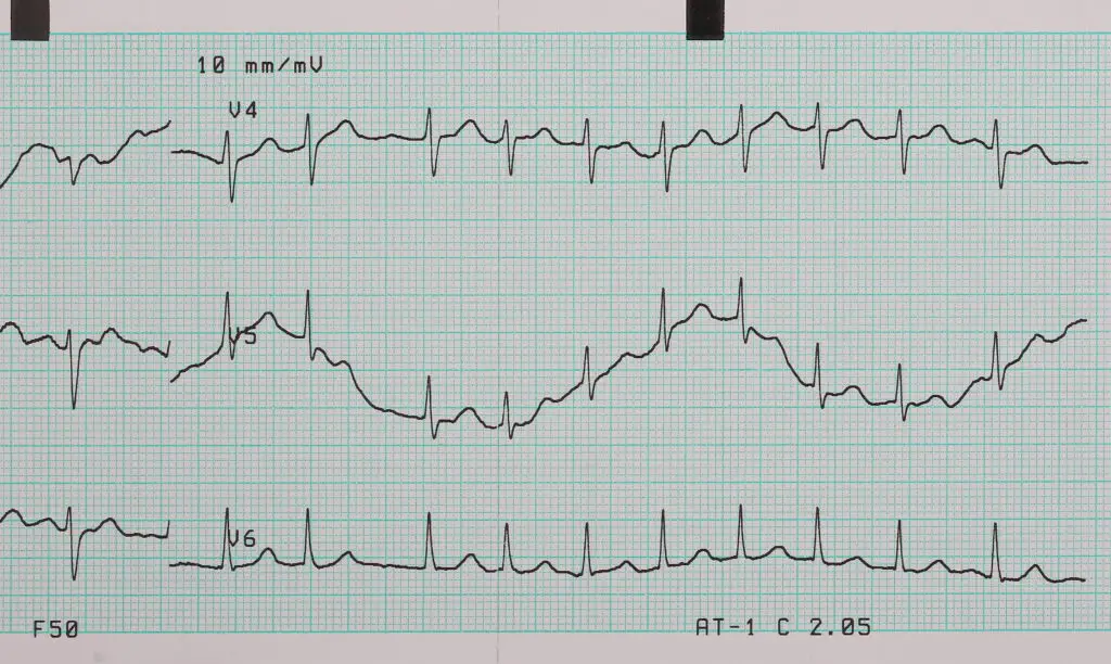 Chronic Heart Failure and Social Security Disability