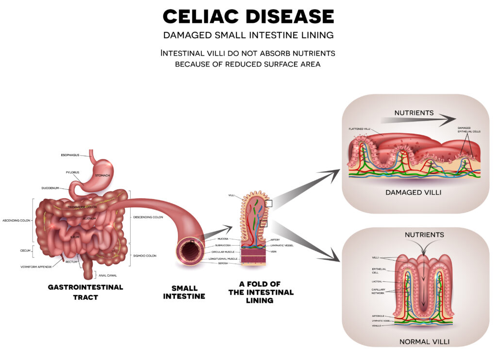 Celiac Disease and Social Security Disability