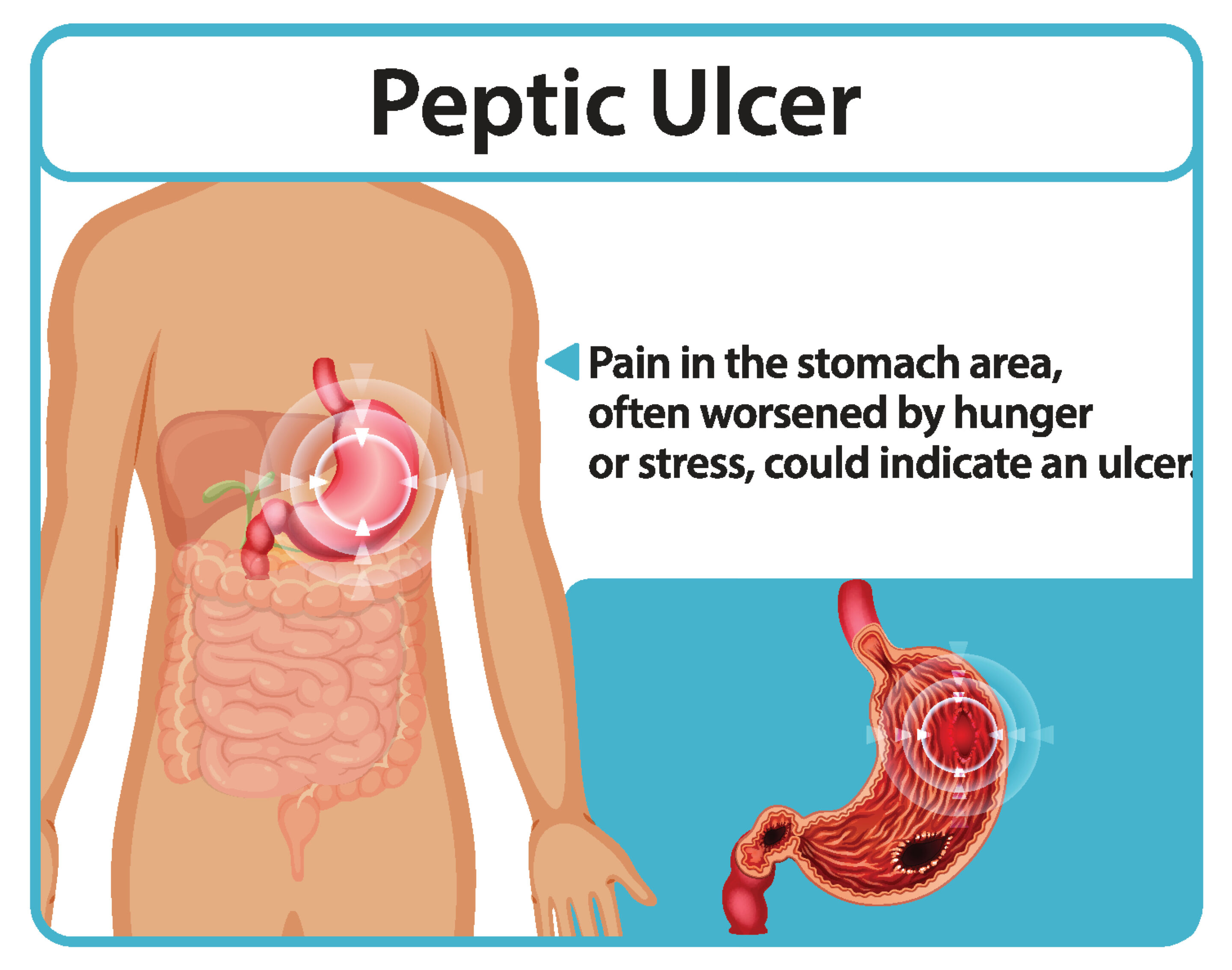Peptic Ulcer Disease and Social Security Disability