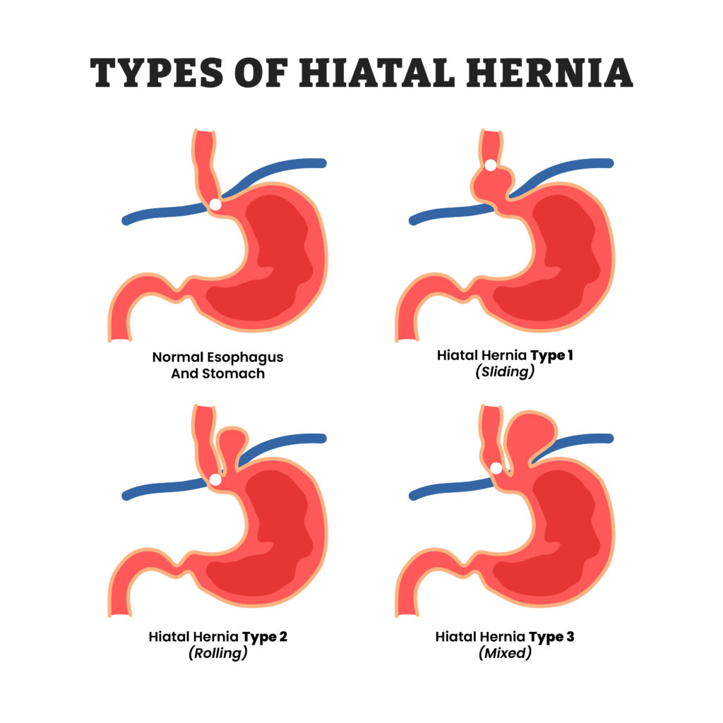 Hiatal Hernias and Social Security Disability