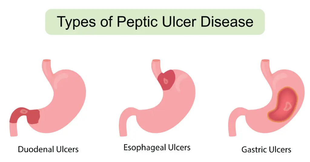 Peptic Ulcer Disease and Social Security Disability