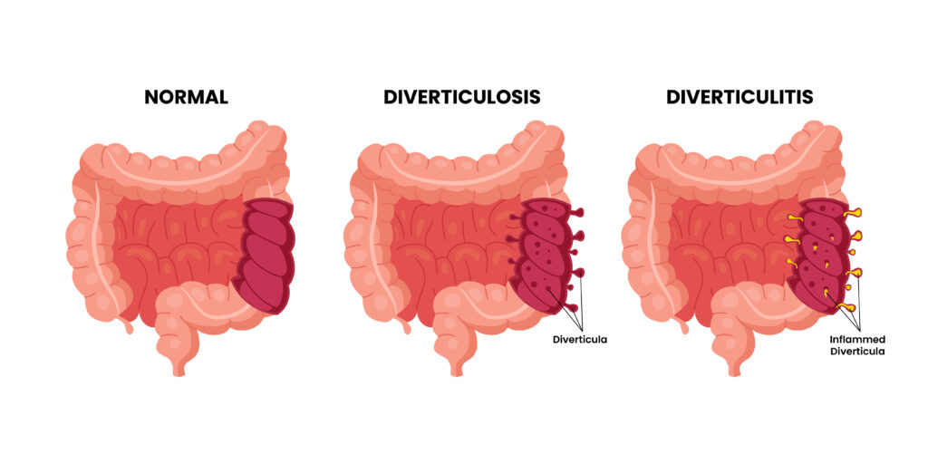 Diverticulitis and Social Security Disability