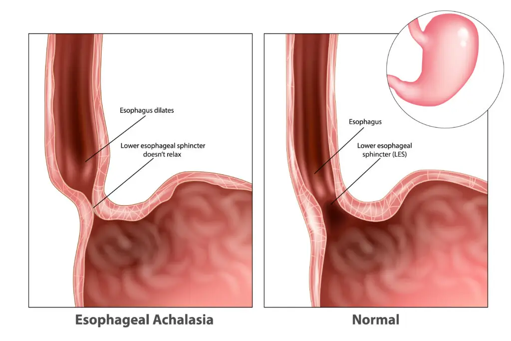 Esophageal Disorders and Social Security Disability