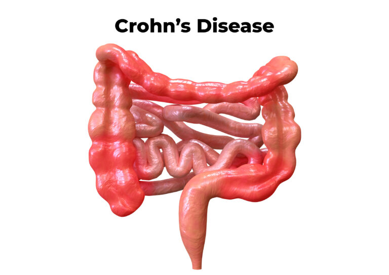 Crohn's Disease and Social Security Disability