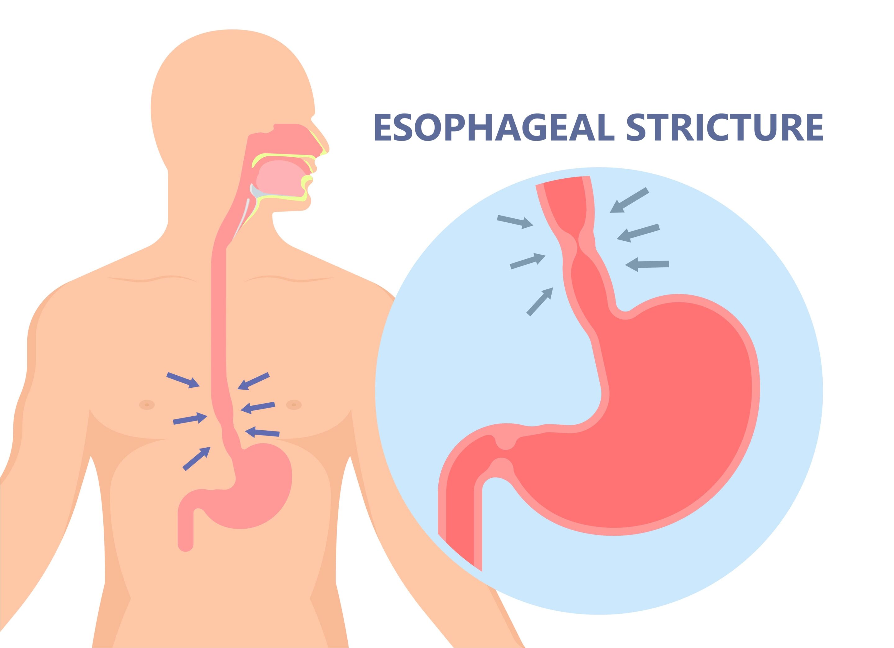 Esophageal Disorders and Social Security Disability