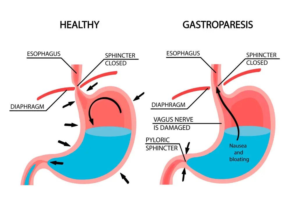 Gastroparesis and Social Security Disability