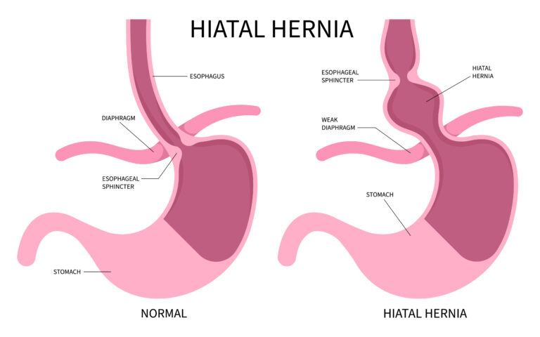 Hiatal Hernias and Social Security Disability