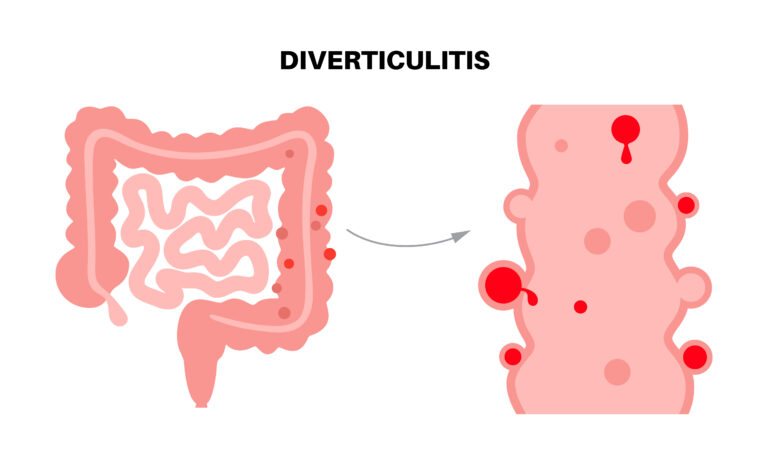 Diverticulitis and Social Security Disability