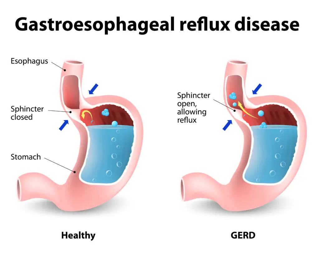 GERD and Social Security Disability