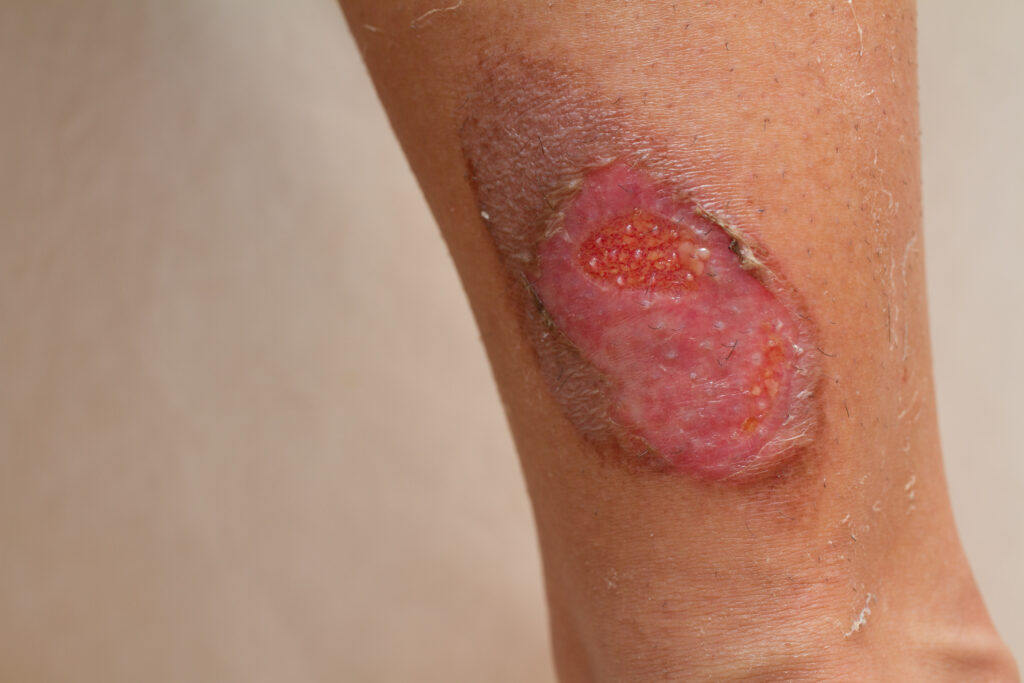 Scarring and Burn Injuries After a Car Wreck