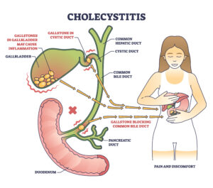 Gallbladder Disease and Social Security Disability