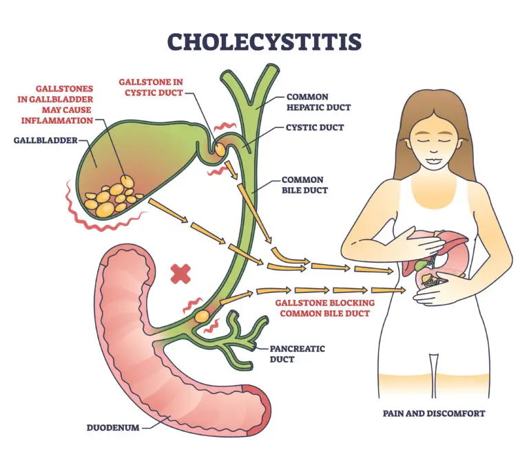 Gallbladder Disease and Social Security Disability