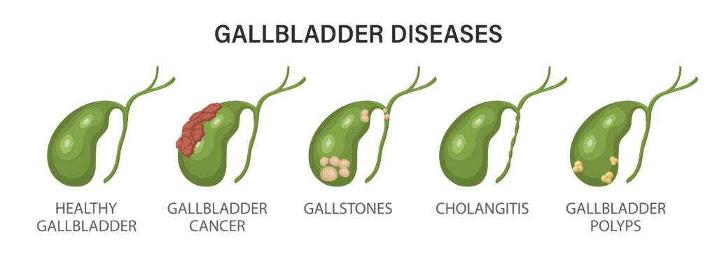 Gallbladder Disease and Social Security Disability