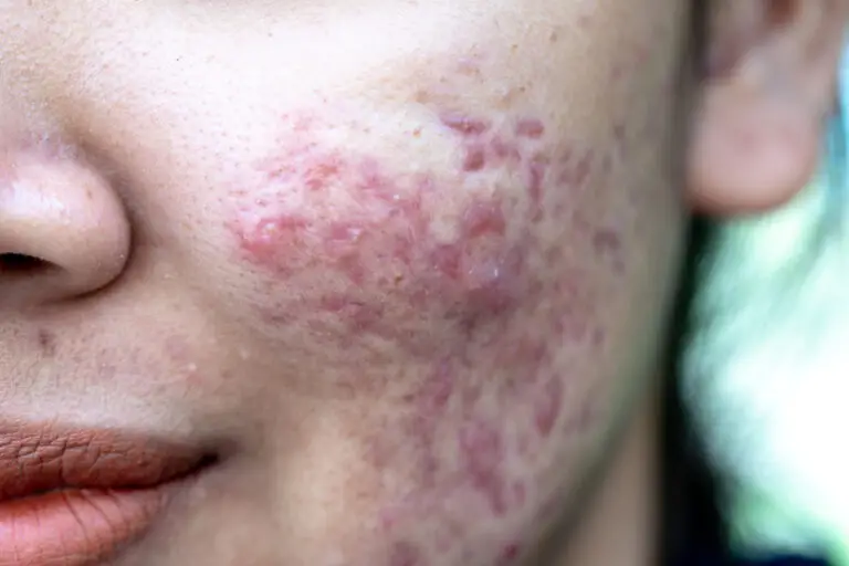 disfigurement damages after a car wreck