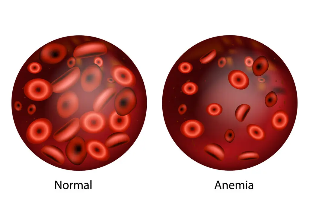 Iron Deficiency Anemia and Social Security Disability