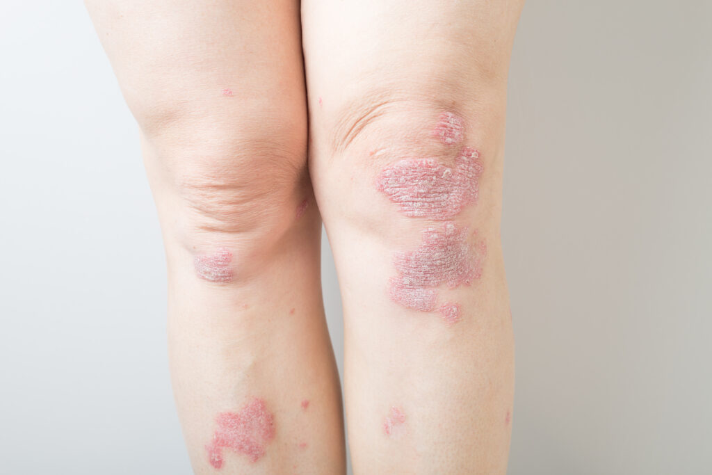 Psoriatic Arthritis and Social Security Disability