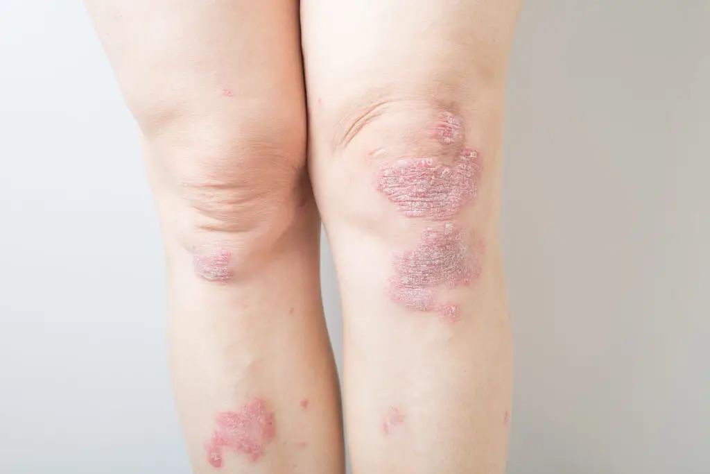 Psoriatic Arthritis and Social Security Disability